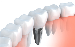 Bone Graft