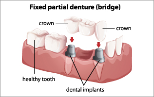 Dental Bridges