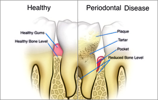 Dental Debridement