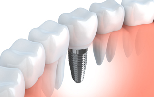 Dental Implant