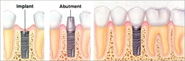 Dental Implant