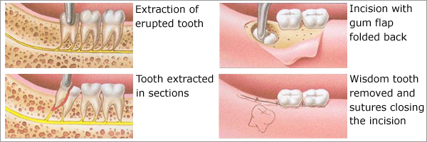 Tooth Extraction