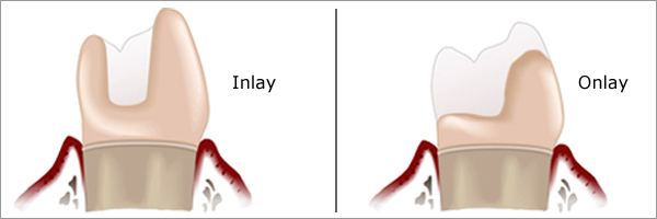 Inlay & Onlay