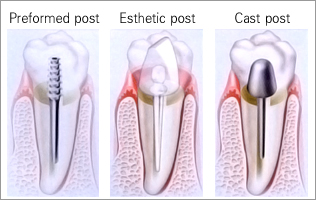 Post and Core