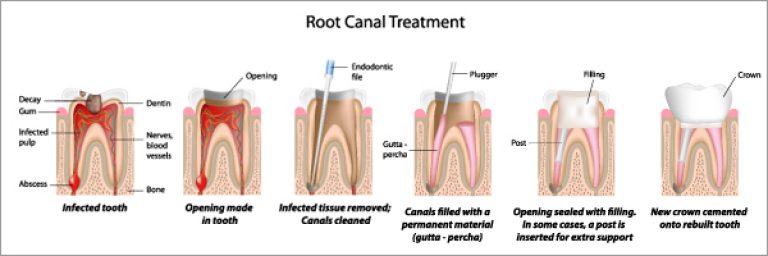 Root Canal Treatment - Phuket Dental Care